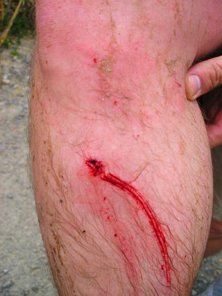 Simon's puncture - not one for the squeamish!