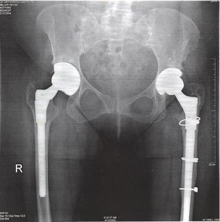 My Bionic Hips