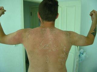 ex-sunburn..